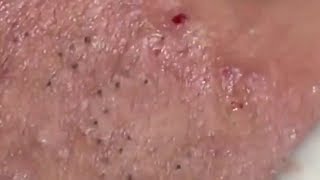 How To Remove Blackheads And Whiteheads On Face Easy 102 ✦ Dr Laelia ✦ [upl. by Nueoht]