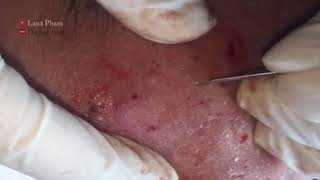 Eps 01 How to Remove Infected Blackheads amp Whiteheads  LANA PHAM [upl. by Gav]