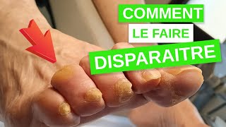 Comment faire disparaître un cor aux pieds [upl. by Anglo]