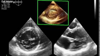 Mitral annular disjunctionMAD  mitral valve prolapse Barlows disease ampmitral incompetence [upl. by Spiegel808]