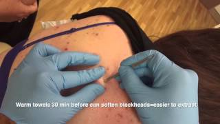 Blackheads back removal  the Australian Anaconda [upl. by Hammerskjold]