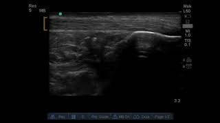 Achilles Tendon Rupture US Annotated JETem 2019 [upl. by Kendry]