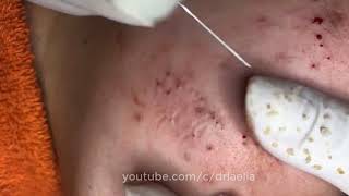 How To Remove Blackheads And Whiteheads On Face Easy 116 ✦ Dr Laelia ✦ [upl. by Burrill]