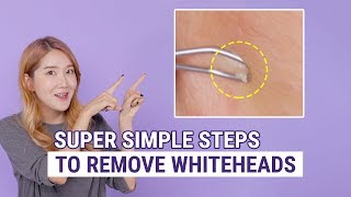 How To Remove Whiteheads  The Best Whitehead Removal amp Prevention Box [upl. by Eob]