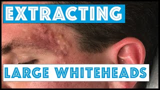 Whitehead Removal Professional Treatments [upl. by Vine]