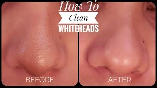 HOW TO REMOVE WHITEHEADS FROM NOSE amp FACE  2019 [upl. by Brightman]