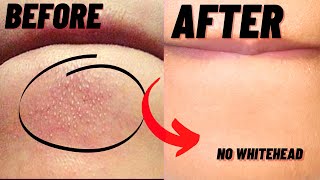 How To Remove Whiteheads And Blackheads From Chin At Home [upl. by Now]