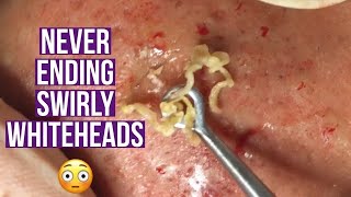 Blackhead and whitehead extractions relaxing amp satisfying [upl. by Aed744]