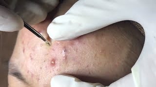 How To Remove Blackheads And Whiteheads On Face Easy 59 ✦ Dr Laelia ✦ [upl. by Hgielra391]