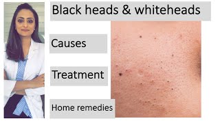 How to remove blackheads amp whiteheads Causes Treatment  Home remedies dermatologist [upl. by Llered]