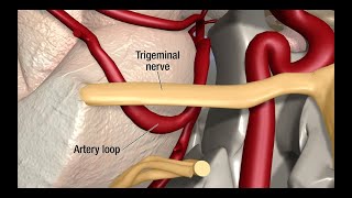 Treatment for Trigeminal Neuralgia UCSF Neurosurgery [upl. by Merrilee886]