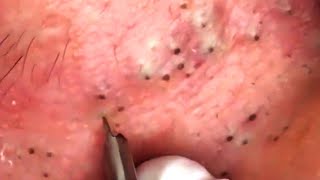 Best Blackheads and Whiteheads Removal 2021 3 [upl. by Ubald]