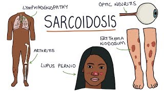 Understanding Sarcoidosis A Visual Guide for Students [upl. by Ojibbob]