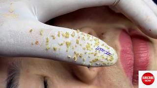 BLACKHEADS AND WHITEHEADS EXTRACTION ON THE FACE 200  Loan Nguyen [upl. by Jeanette968]