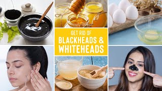 Easy Ways To Remove Blackheads And Whiteheads At Home [upl. by Viridi510]