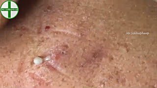 Deep Whiteheads Removal On Face  Acne Treatment 171112 [upl. by Eimor848]