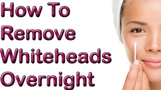 How To Remove Whiteheads Overnight  1 REMEDY To Remove Whitehead [upl. by Pincus]