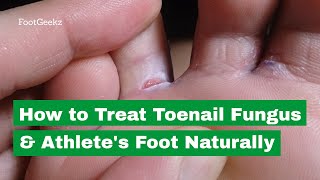 How to Treat Toenail Fungus amp Athletes Foot Naturally [upl. by Jewel]