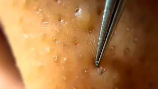 BLACKHEADS AND WHITEHEADS REMOVAL BY TWEEZERS [upl. by Isborne]